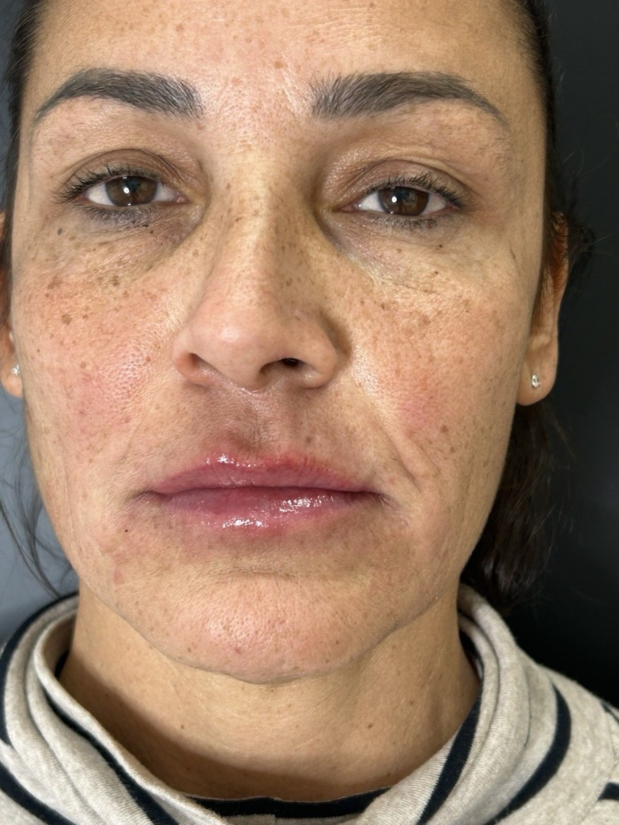 Después labios