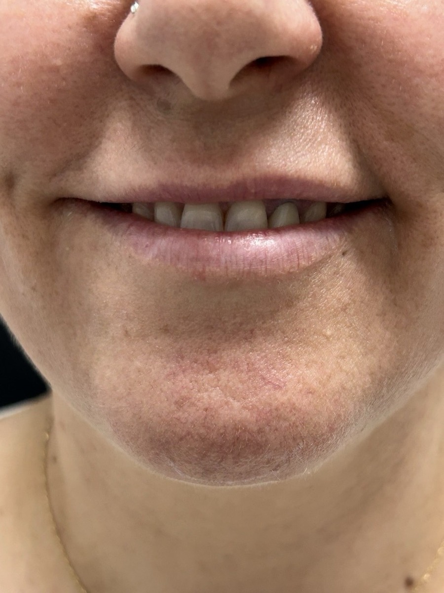 Antes perfilado labial