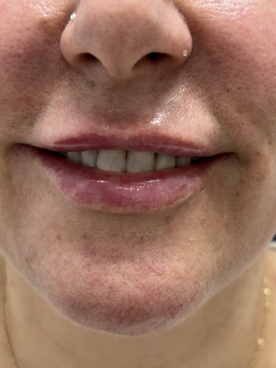 Después perfilado labial