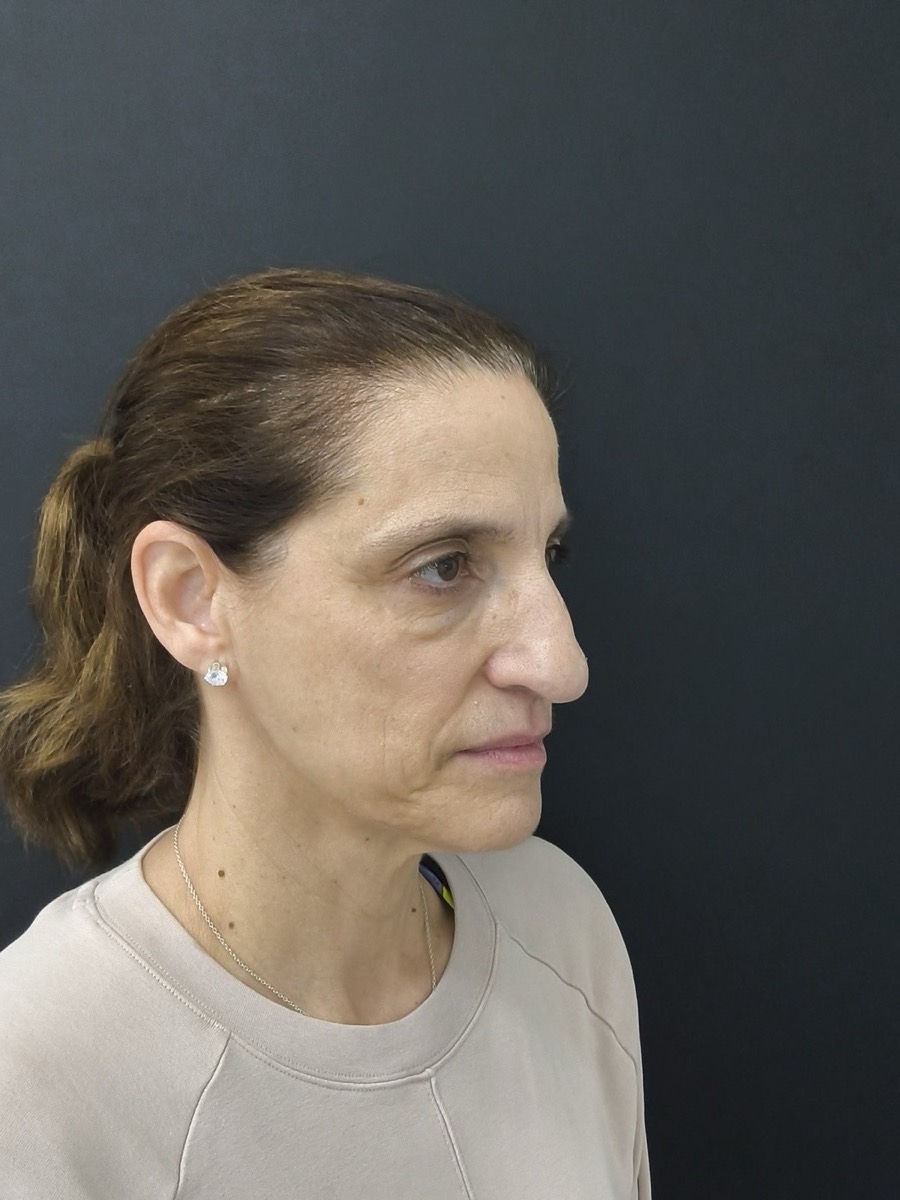 Antes rejuvenecimiento facial